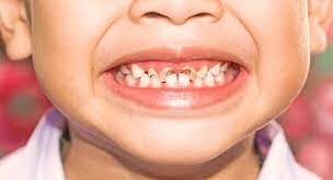 Caries chez les enfants : cause symptomes et mode de traitement