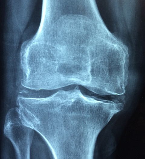 Comment prévenir l’arthrose des genoux ?